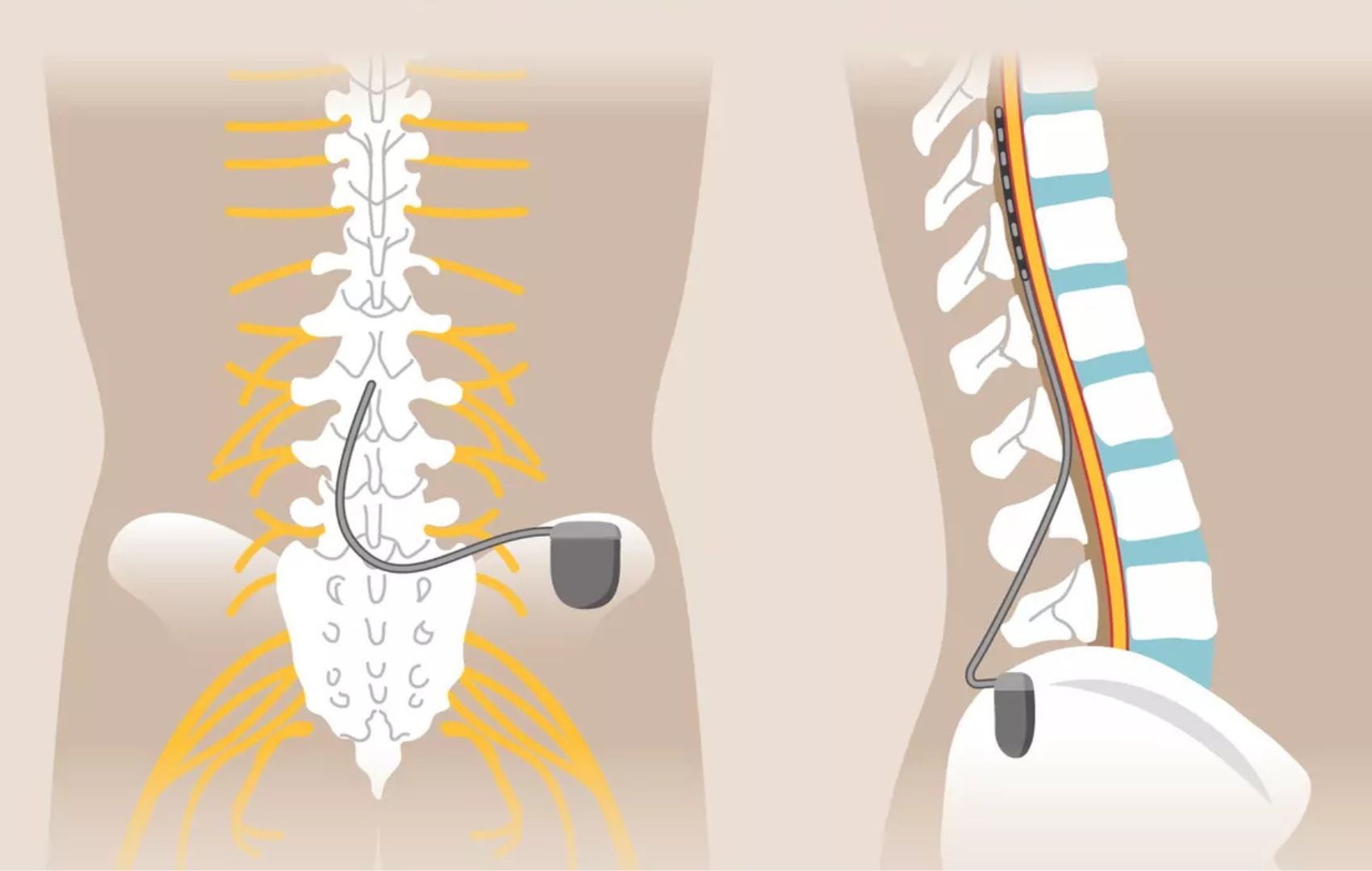 Estudo recente concluiu que a estimula��o medular n�o melhorou a marcha no Parkinson