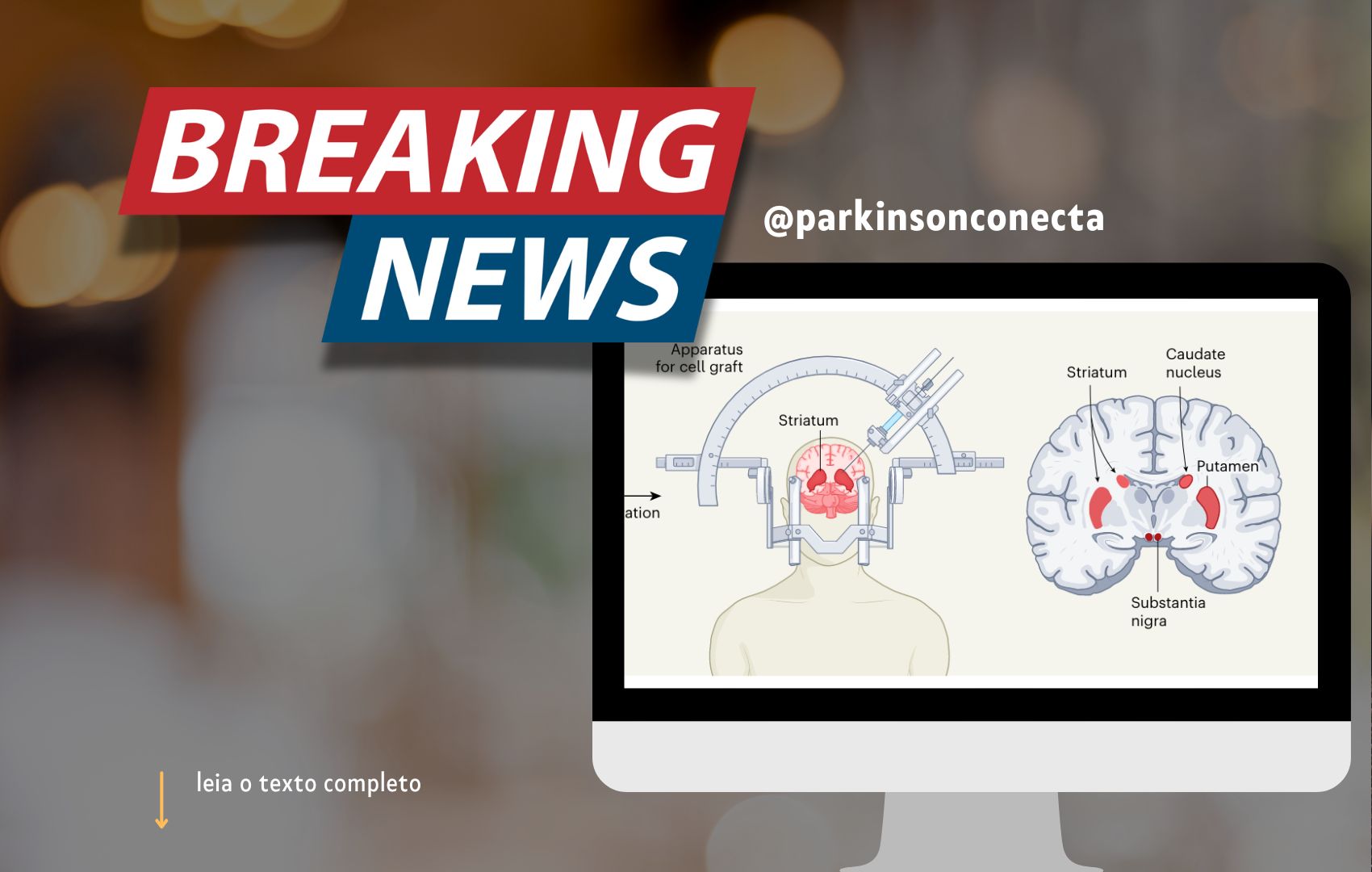 Terapia com c�lulas tronco na doen�a de Parkinson: estudos publicados ontem mostraram SEGURAN�A!